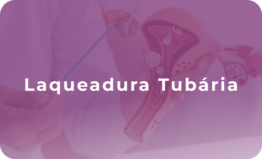 Laqueadura Tubária